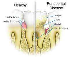 Gum Disease Treatment